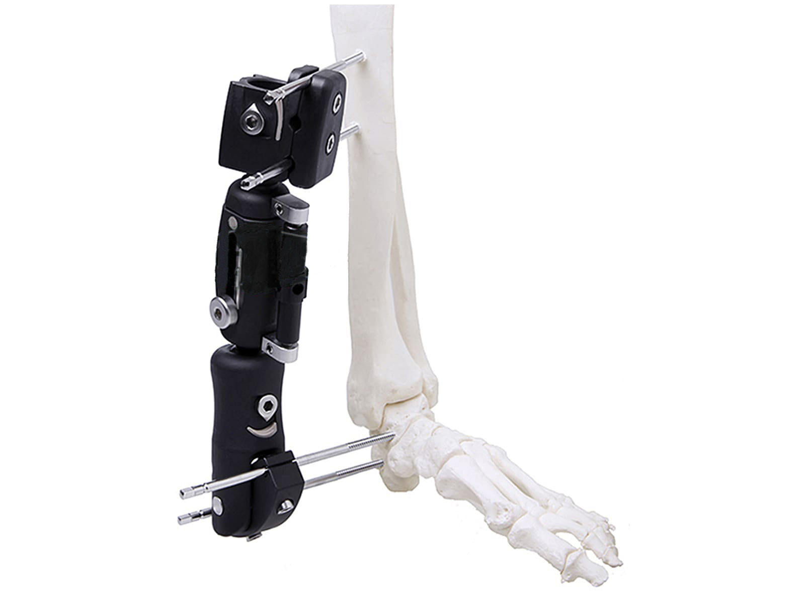 Ankle Joint External Fixator in PEEK