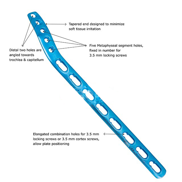 fixLOCK Distal Lateral Humerus Plate, Extra Articular